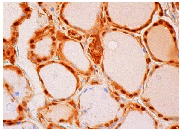 Uev1A (H-6): sc-390047. Immunoperoxidase staining of formalin fixed, paraffin-embedded human thyroid tissue showing nuclear and cytoplasmic staining of glandular cells.