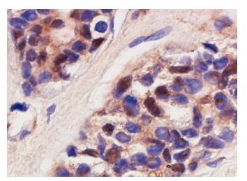 USF-2 (C-20): sc-862. Immunoperoxidase staining of formalin-fixed, paraffin-embedded human breast tumor showing nuclear staining.