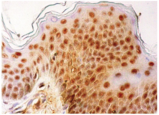 XPA (12F5): sc-56813. Immunoperoxidase staining of formalin fixed, paraffin-embedded human skin tissue showing nuclear and cytoplasmic staining of fibroblasts, keratinocytes Langerhans cells and melanocytes.