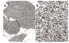 YY1 (H-414): sc-1703. Immunoperoxidase staining of formalin fixed, paraffin-embedded human parathyroid gland tissue showing nuclear staining of glandular cells at low (A) and high (B) magnification. Kindly provided by The Swedish Human Protein Atlas (HPA) program.