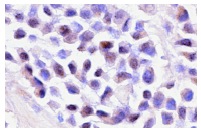 RARα (C-20): sc-551. Immunoperoxidase staining of formalin-fixed, paraffin-embedded human breast tumor showing nuclear and cytoplasmic staining.