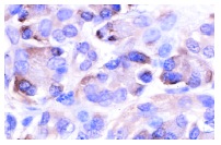 ICAD (K-17): sc-6867. Immunoperoxidase staining of formalin-fixed, paraffin-embedded human pancreas tissue showing cytoplasmic staining.
