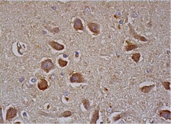 p-GSK-3α/β (Tyr 279/ Tyr 216)-R: sc-11758-R. Immunoperoxidase staining of formalin fixed, paraffin-embedded human hippocampus tissue showing cytoplasmic staining of neuronal cells and glial cells.