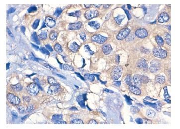 JNK (D-2): sc-7345. Immunoperoxidase staining of formalin-fixed, paraffin-embedded human breast carcinoma tissue showing cytoplasmic staining.