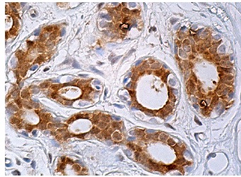 JNK1 (D-6): sc-137018. Immunoperoxidase staining of formalin fixed, paraffin-embedded human breast tissue showing cytoplasmic and nuclear staining of glandular cells.