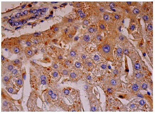 PFK-2 liv (H-45): sc-48828. Immunoperoxidase staining of formalin fixed, paraffin-embedded human liver tissue showing cytoplasmic staining of hepatocytes, bile duct cells and hepatic sinusoid cells.
