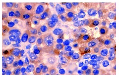 Pim-2 (1D12): sc-13514. Immunoperoxidase staining of formalin fixed, paraffin-embedded mouse lymphoma tissue showing cytoplasmic localization.