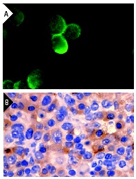 Pim-2 (1D12): sc-13514. Immunofluorescence staining of methanol-fixed CTLL-2 cells showing membrane staining (A). Immunoperoxidase staining of formalin fixed, paraffin-embedded mouse lymphoma tissue showing cytoplasmic localization (B).