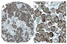 HCC-1 (E-5): sc-28388. Immunoperoxidase staining of formalin fixed, paraffin-embedded human salivary gland tissue showing cytoplasmic staining of glandular cells (low and high magni?fication). Kindly provided by The Swedish Human Protein Atlas (HPA) program.