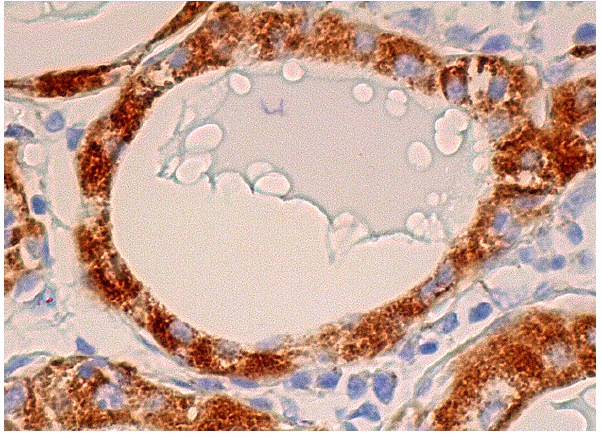 IGFBP6 (H-70) : sc-13094. Immunoperoxidase staining of formalin fixed, paraffin-embedded human thyroid gland tissue showing cytoplasmic staining of glandular cells.