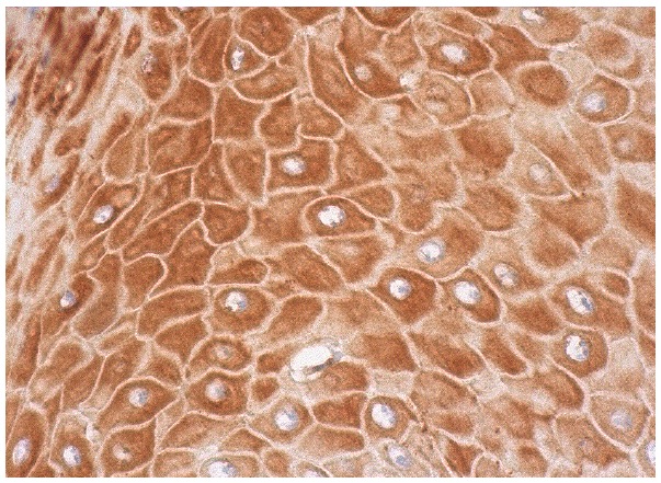 NF2 (H-260): sc-28247. Immunoperoxidase staining of formalin fixed, paraffin-embedded human oral mucosa tissue showing cytoplasmic staining of squamous epithelial cells.
