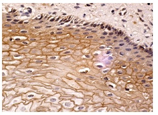 TGase1 (H-87): sc-25786. Immunoperoxidase staining of formalin fixed, paraffin-embedded human cervix tissue showing membrane staining of squamous epithelial cells.