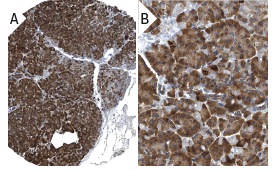 BAP31 (H-90): sc-48766. Immunoperoxidase staining of formalin fixed, paraffin-embedded human pancreas tissue showing cytoplasmic staining of exocrine glandular cells and islet cells at low (A) and high (B) magnification. Kindly provided by The Swedish Human Protein Atlas (HPA) program.