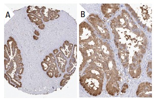 TGase4 (T-19): sc-55791. Immunoperoxidase staining of formalin fixed, paraffin-embedded human prostate tissue showing cytoplasmic staining of glandular cells in low (A) and high (B) resolution. Kindly provided by The Swedish Human Protein Atlas (HPA) program.