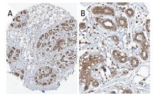 TIGAR (Y-20): sc-68239. Immunoperoxidase staining of formalin fixed, paraffin-embedded human breast tissue showing nuclear and cytoplasmic staining of glandular cells in low (A) and high (B) resolution. Kindly provided by The Swedish Human Protein Atlas (HPA) program.