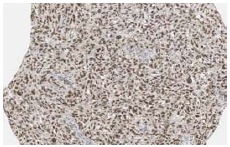 XRCC1 (H-300): sc-11429. Immunoperoxidase staining of formalin fixed, paraffin-embedded human malignant melanoma showing nuclear staining of tumor cells. Kindly provided by The Swedish Human Protein Atlas (HPA) program.
