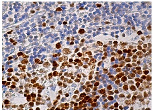 MCM5 (E-10): sc-165994. Immunoperoxidase staining of formalin fixed, paraffin-embedded human tonsil tissue showing nuclear staining of cells in germinal centers.