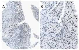 NIFK (18E148): sc-52904. Immunoperoxidase staining of formalin fixed, paraffin-embedded human urinary bladder tissue showing nucleolar staining of urothelial cells (low and high magnification). Kindly provided by The Swedish Human Protein Atlas (HPA) program.