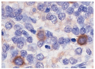 R2 (E-16): sc-10846. Immunoperoxidase staining of formalin-fixed, paraffin-embedded human lymphoma showing cytoplasmic staining.