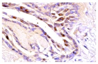 Skp1 p19 (C-20): sc-1568. Immunoperoxidase staining of formalin-fixed, paraffin-embedded human lymphoma showing nuclear staining.