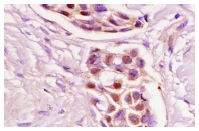 Skp1 p19 (H-6): sc-5281. Immunoperoxidase staining of formalin-fixed, paraffin-embedded human breast tumor showing nuclear staining.