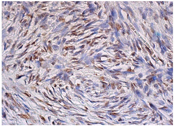 HoxB3 (H-50): sc-28606. Immunoperoxidase staining of formalin fixed, paraffin-embedded human ovary tissue showing nuclear staining of ovarian stroma cells.