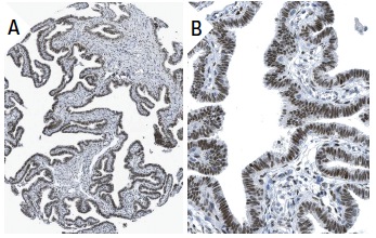 Pbx 1/2/3/4 (F-3): sc-28313. Immunoperoxidase staining of formalin fixed, paraffin-embedded human fallopian tube tissue showing nuclear staining of glandular cells (low and high magnification). Kindly provided by The Swedish Human Protein Atlas (HPA) program.