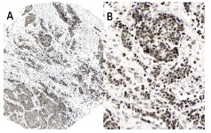 PREP-1 (B-2): sc-25282. Immunoperoxidase staining of formalin fixed, paraffin-embedded human cervical cancer tissue showing nuclear staining of tumor cells at low (A) and high (B) magnification. Kindly provided by The Swedish Human Protein Atlas (HPA) program.