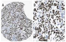 AP-2g (AP2g 6E4/4): sc-53162. Immunoperoxidase staining of formalin fixed, paraffin-embedded human testis cancer tissue showing nuclear staining of tumor cells at low (A) and high (B) magnification. Kindly provided by The Swedish Human Protein Atlas (HPA) program.
