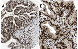 ALY (11G5): sc-32311. Immunoperoxidase staining of formalin fixed, paraffin-embedded human gall bladder tissue showing nuclear and cytoplasmic staining of glandular cells (low and high magnification). Kindly provided by The Swedish Human Protein Atlas (HPA) program.