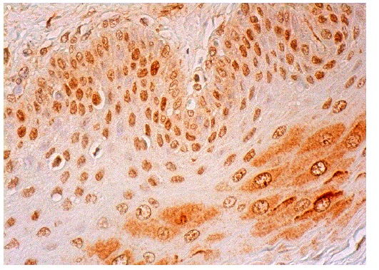 BAF155 (C-19): sc-9747. Immunoperoxidase staining of formalin fixed, paraffin-embedded human esophagus tissue showing nuclear and cytoplasmic staining of squamous epithelial cells.