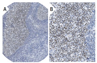 BAF155 (DXD7): sc-32763. Immunoperoxidase staining of formalin fixed, paraffin-embedded human lymph node tissue showing nuclear staining of lymphoid cells at low (A) and high (B) magnification. Kindly provided by The Swedish Human Protein Atlas (HPA) program.