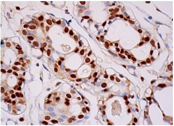 BAF170 (E-6): sc-17838. Immunoperoxidase staining of formalin fixed, paraffin-embedded human breast tissue showing nuclear staining of glandular cells.