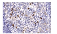 Blimp-1 (6D3): sc-47732. Immunoperoxidase staining of human tonsil showing Blimp-1 positive cells in the germinal center. Kindly provided by Dr. L Corcoran of the The Walter and Eliza Hall Institute and Dr. T Marafioti of Oxford University.