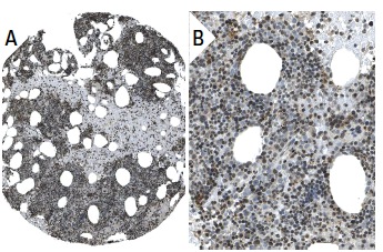 SDF-1 (FL-93): sc-28876. Immunoperoxidase staining of formalin fixed, paraffin-embedded human bone marrow tissue showing nuclear and cytoplasmic staining of bone marrow poietic cells (low and high magnification). Kindly provided by The Swedish Human Protein Atlas (HPA) program.