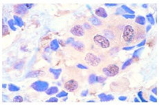 HSC 70 (B-6): sc-7298. Immunoperoxidase staining of formalin-fixed, paraffin-embedded human breast carcinoma tissue showing nuclear and cytoplasmic localization.