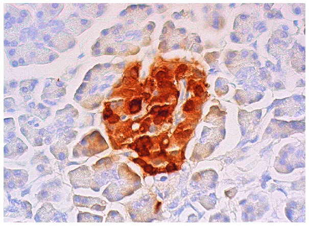 Somatostatin (H-11): sc-74556. Immunoperoxidase staining of formalin fixed, paraffin-embedded human pancreas tissue showing cytoplasmic staining of Islets of Langerhans.