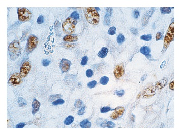 HSP 105 (N-187): sc-6241. Immunoperoxidase staining of formalin-fixed, paraffin-embedded human colon carcinoma tissue showing nuclear staining.