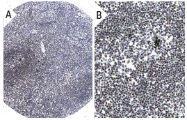 IFI-16 (1G7): sc-8023. Immunoperoxidase staining of formalin fixed, paraffin-embedded human lymph node tissue showing nuclear staining of lymphoid cells (low and high magnification). Kindly provided by The Swedish Human Protein Atlas (HPA) program.