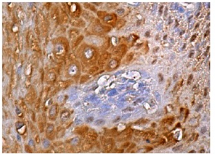 MAT Iα/IIα (B-10): sc-166452. Immunoperoxidase staining of formalin fixed, paraffin-embedded human esophagus tissue showing cytoplasmic and nuclear staining of squamous epithelial cells.