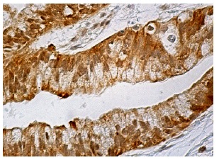 MLF2 (B-6): sc-166874. Immunoperoxidase staining of formalin fixed, paraffin-embedded human gall bladder tissue showing nuclear and cytoplasmic staining of glandular cells.