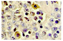 MYPT1 (H-130): sc-25618. Immunoperoxidase staining of formalin fixed, paraffin-embedded human brain tumor showing cytoplasmic localization in selected cells.