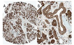 VEGF (A-20): sc-152. Immunoperoxidase staining of formalin fixed, paraffin-embedded human soft tissue showing cytoplasmic staining of chondrocytes, endothelial cells, and perineural cells at low (A) and high (B) magnification. Kindly provided by The Swedish Human Protein Atlas (HPA) program.