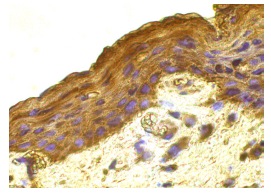 VEGF(A-20): sc-152. Immunoperoxidase staining of formalin fixed, paraffin-embedded human cervix tissue showing cytoplasmic staining of squamous epithelial cells.