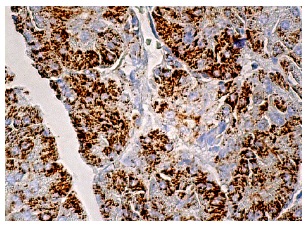 NRAMP 2 (G-5): sc-166884. Immunoperoxidase staining of formalin fixed, paraffin-embedded human pancreas tissue showing cytoplasmic staining of glandular cells.