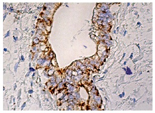 NRAMP 2 (G-5): sc-166884. Immunoperoxidase staining of formalin fixed, paraffin-embedded human pancreas tissue showing cytoplasmic staining of pancreatic ducts.