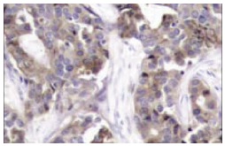 p-Op18 (Ser 25): sc-101809. Immunoperoxidase staining of formalin-fixed, paraffin-embedded human breast carcinoma tissue showing cytoplasmic staining.