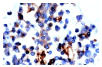 OPN (AKm2A1): sc-21742. Immunoperoxidase staining of formalin-fixed, paraffin-embedded human bone marrow showing cytoplasmic and extracellular staining.