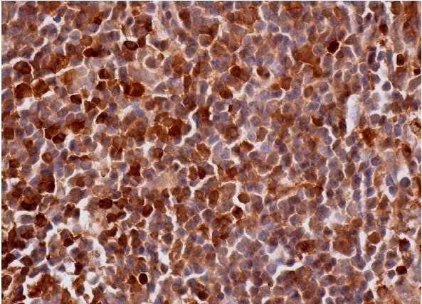 RGS10 (C-20): sc-6206. Immunoperoxidase staining of formalin fixed, paraffin-embedded human lymph node tissue showing cytoplasmic and nuclear staining of cells in germinal and non-germinal centers.