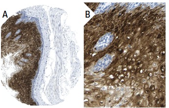SCCA1/2 (B-9): sc-28384. Immunoperoxidase staining of formalin fixed, paraffin-embedded human esophagus tissue showing cytoplasmic and nuclear staining of squamous epithelial cells (low and high magnification). Kindly provided by The Swedish Human Protein Atlas (HPA) program.
